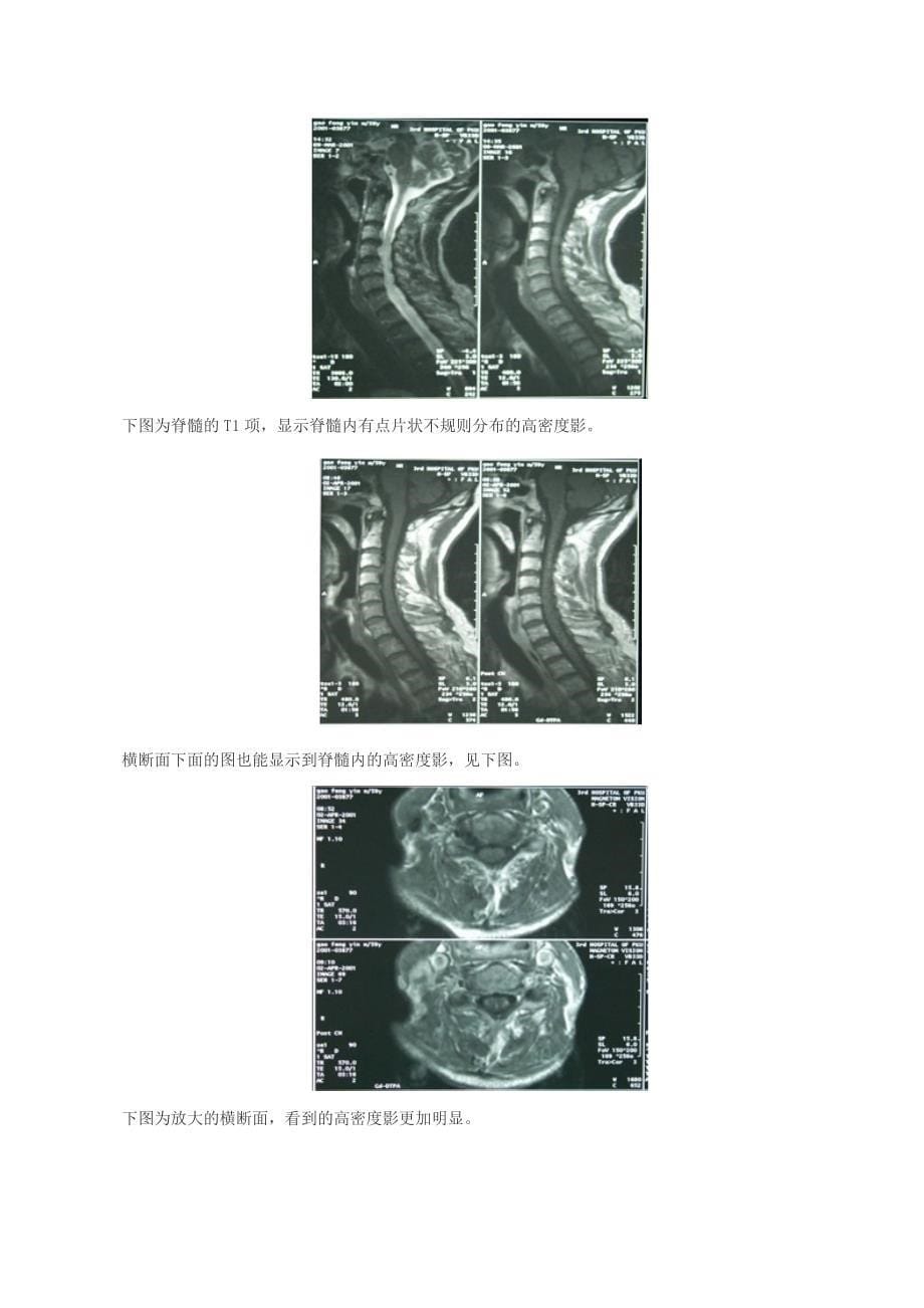 影响颈椎病外科治疗结果的因素.docx_第5页