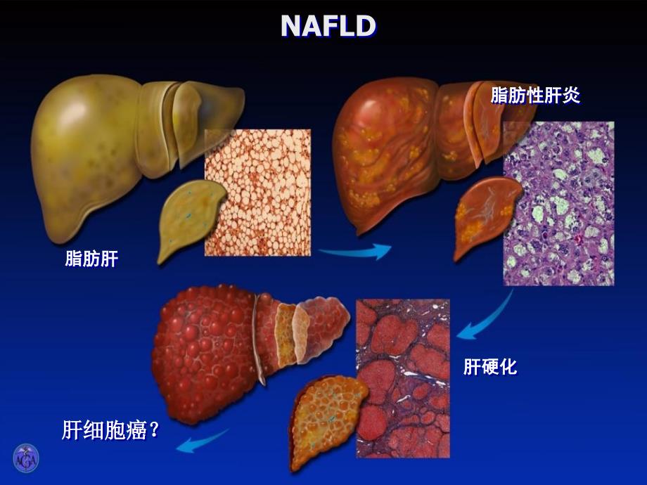 非酒精性脂肪肝的中医治疗_第4页