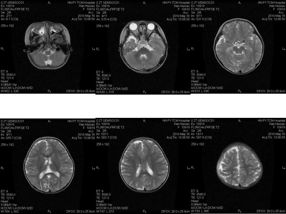 mri部分颅脑典型病例_第3页