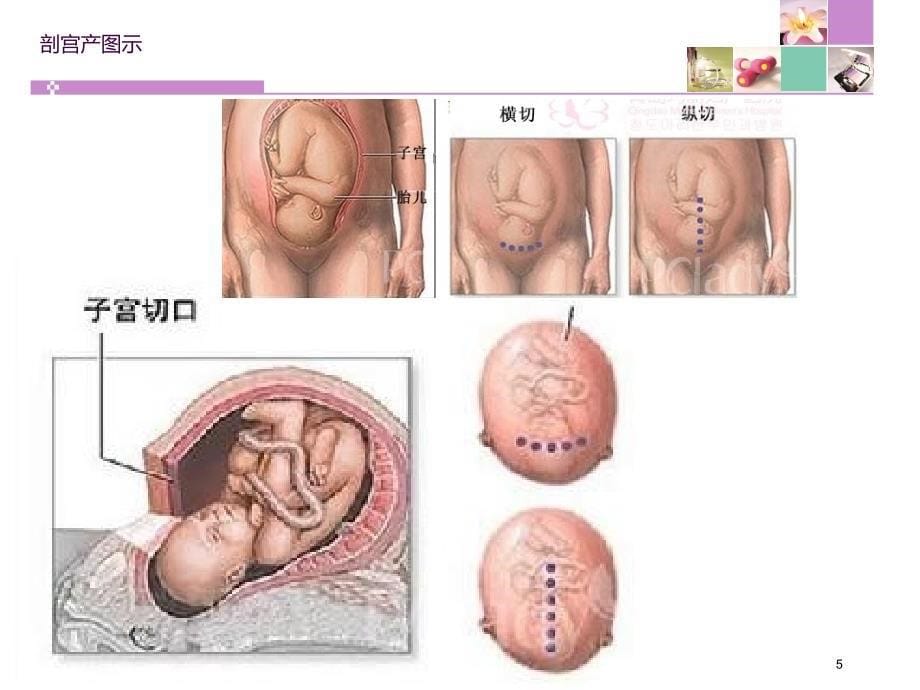 剖宫产术后护理教学查房ppt课件_第5页