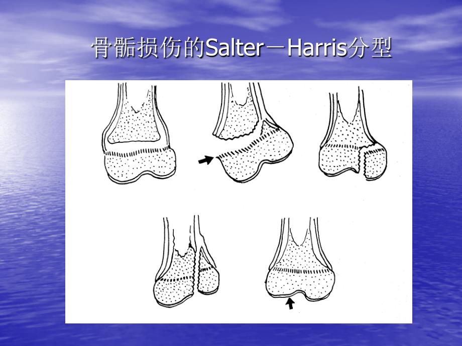 小儿肘部损伤的诊断与处理_第4页