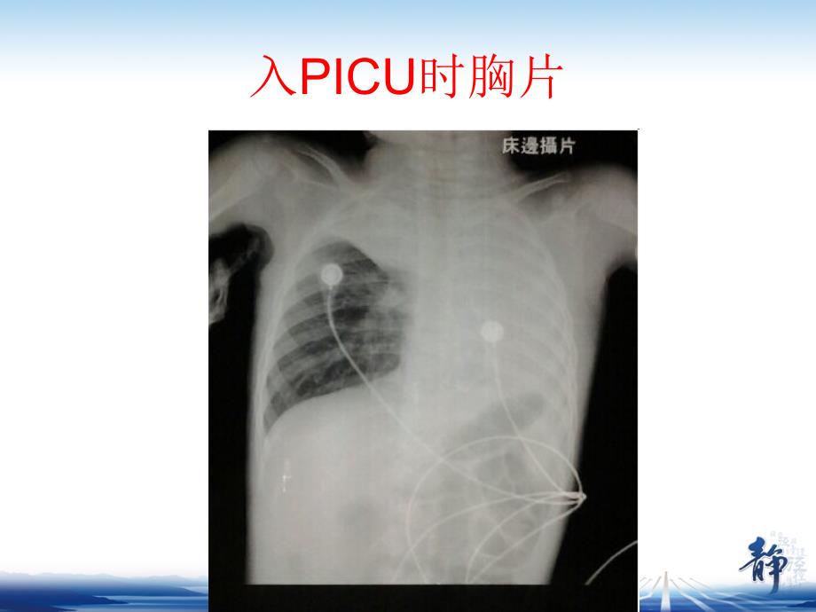 镇痛镇静典型病例分析p阳pt课件_第4页