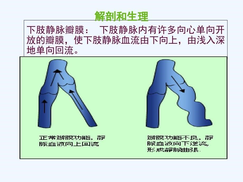 下肢静脉曲张介入治疗的护理课件_第5页