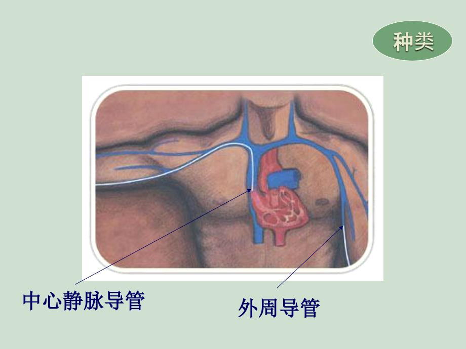 合理选择静脉输液工具_第4页