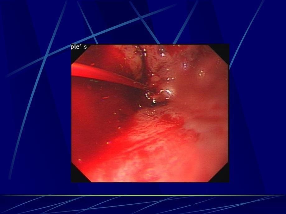 消化道出血优秀课件_第5页