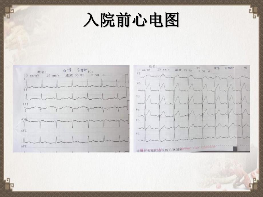 急诊PCI术中非罪犯血管闭塞例_第4页