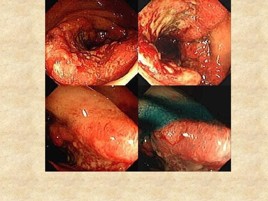 下消化道出血lowergastrointestinalhemorrhage_第5页