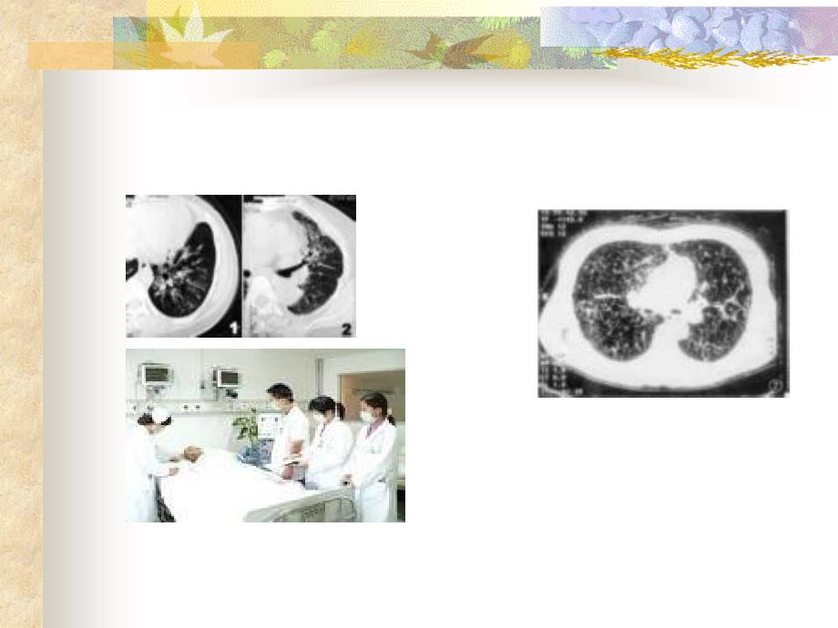 最新四节咯血hemoptysis精品课件_第2页