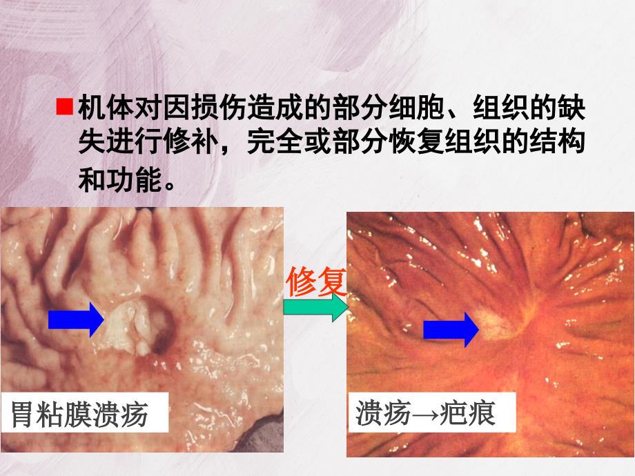 病理学损伤修复(修改)_第4页