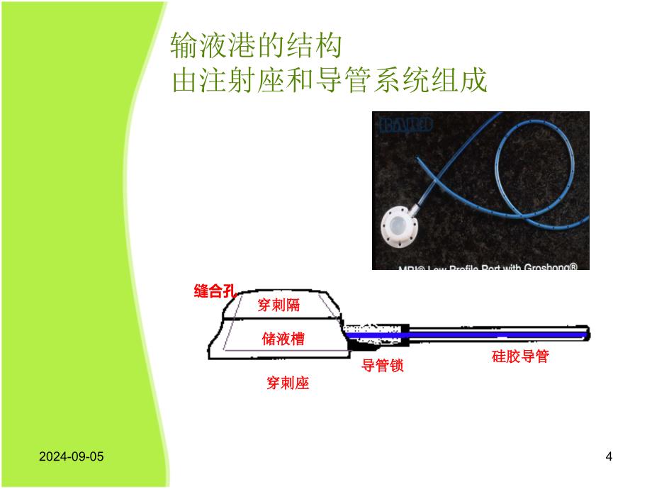 医学输液港穿刺操作及维护注意事项优秀课件_第4页