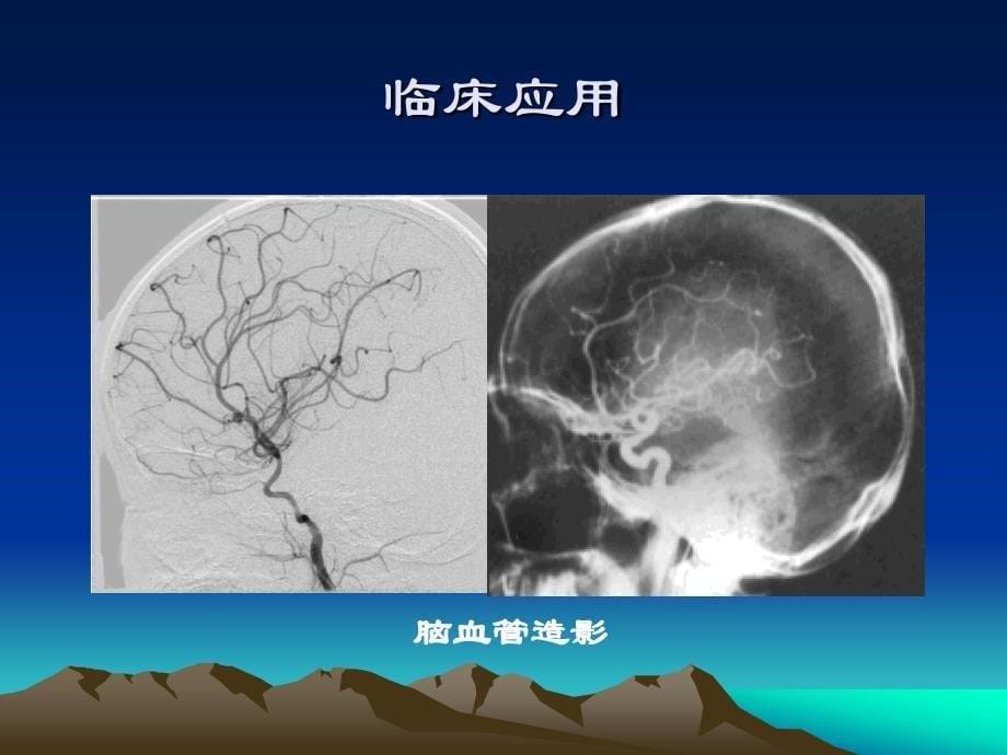 DSA设备及成像原理_第5页