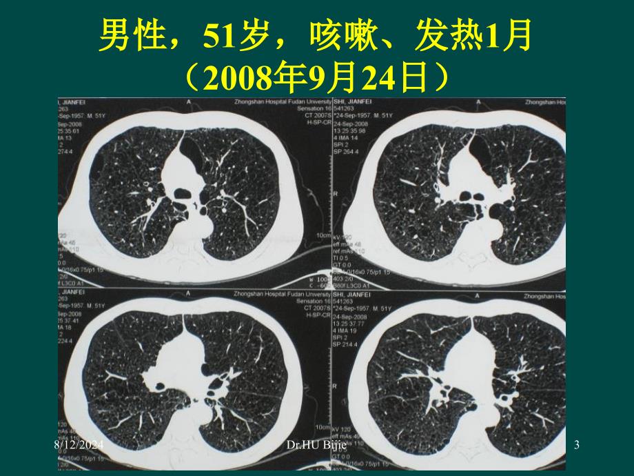 肺真菌感染的诊断进展与治疗疗效_第3页