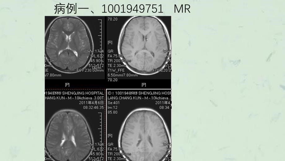 结节性硬化症课件_第5页