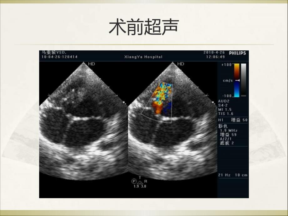 室缺封堵术后残余分流追踪观察1例_第3页