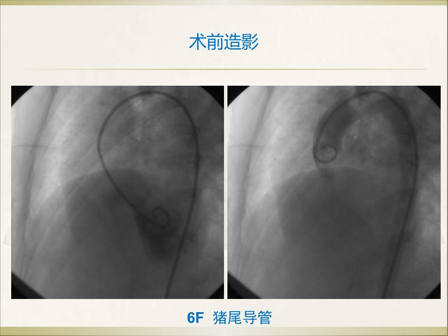 室缺封堵术后残余分流追踪观察1例_第4页