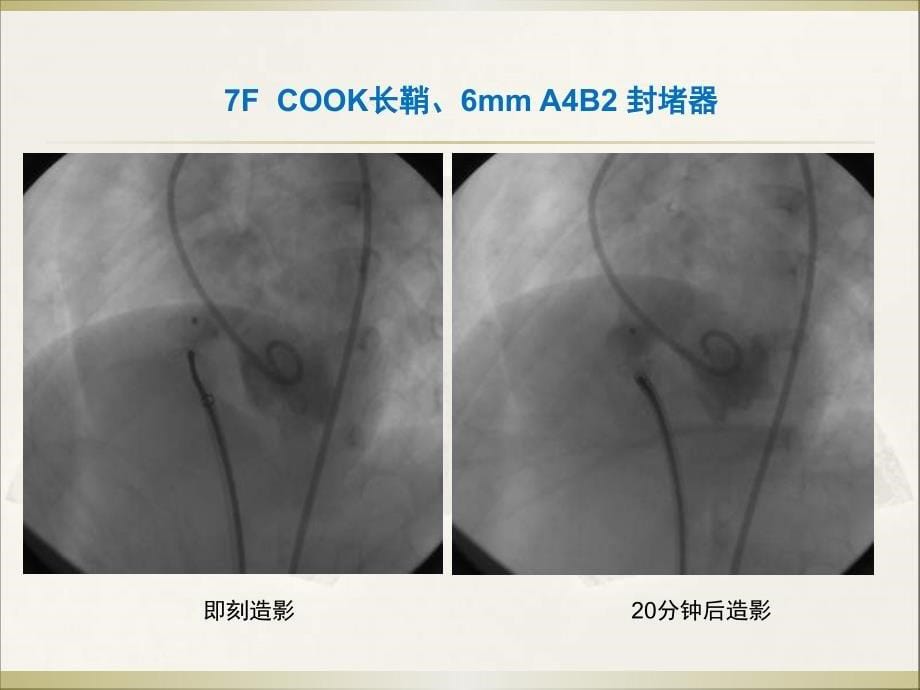 室缺封堵术后残余分流追踪观察1例_第5页