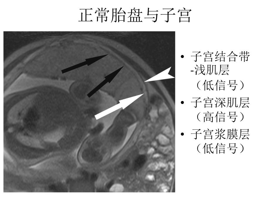 胎盘植入的磁共振表现_第3页