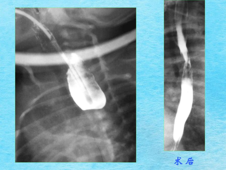 常见消化道畸形影像诊断ppt课件_第4页