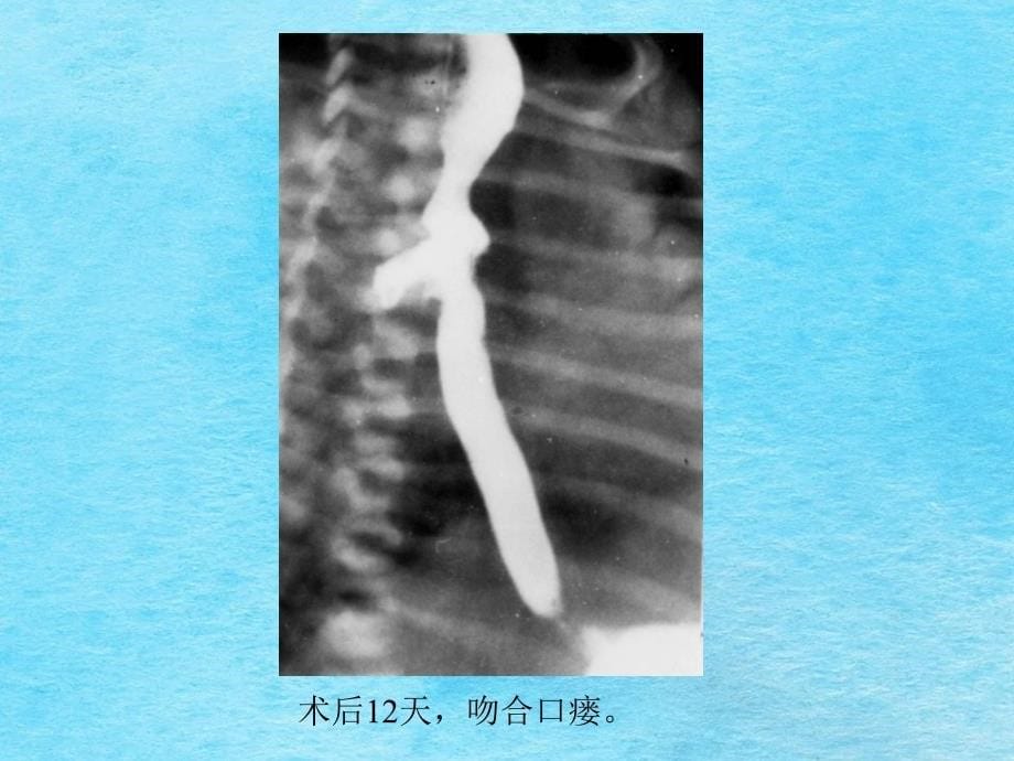 常见消化道畸形影像诊断ppt课件_第5页