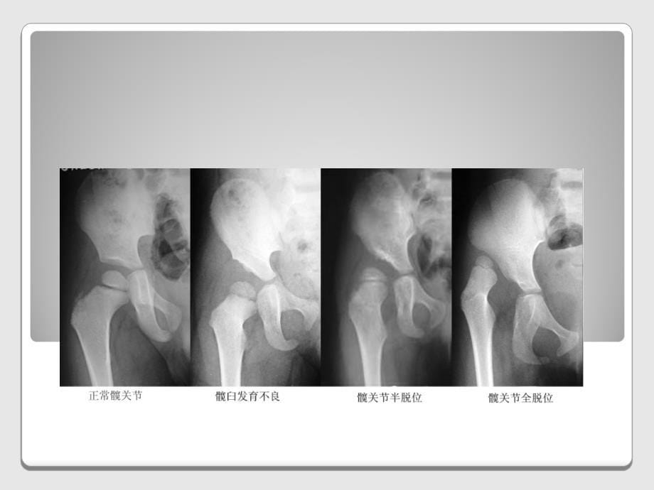 DDH的X线诊断蒋菊芬_第5页