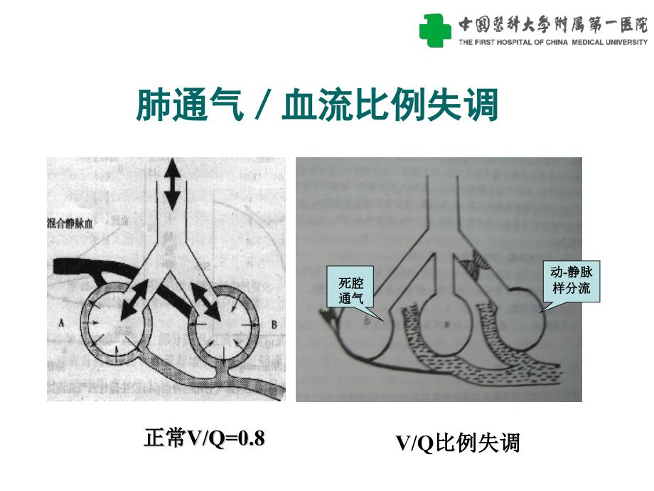 医学专题：慢性呼吸衰竭_第4页