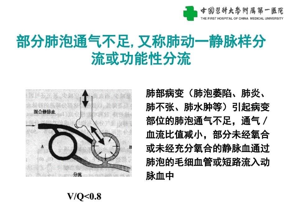 医学专题：慢性呼吸衰竭_第5页