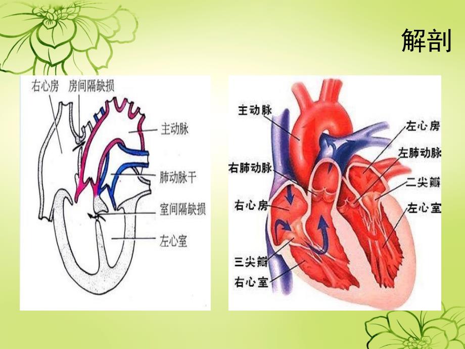 房间隔缺损护理查房.ppt_第3页