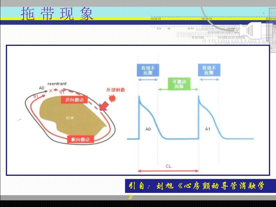 拖带技术在房颤射频消融中的应用_第4页