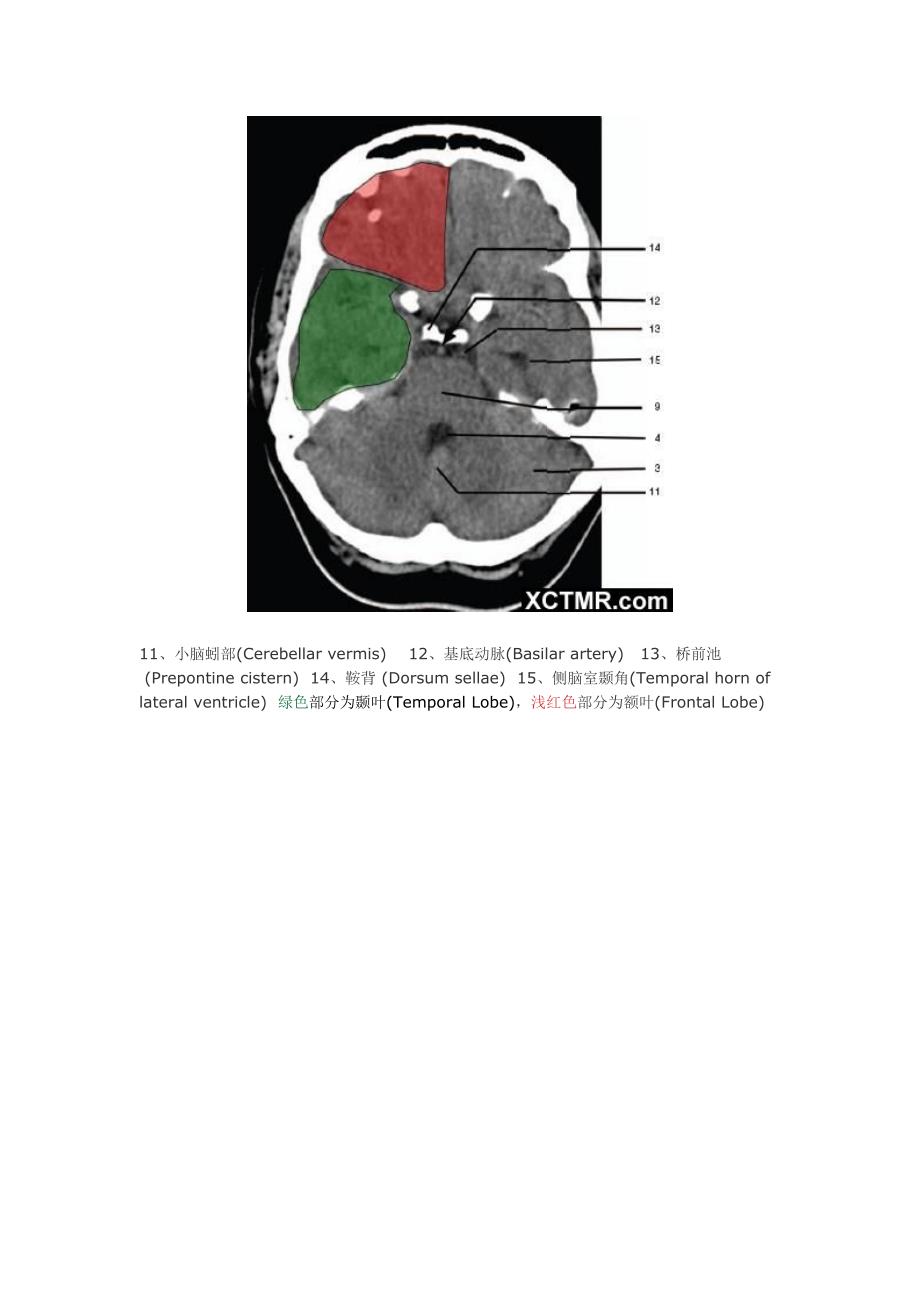 颅脑CT解剖(图文).doc_第3页