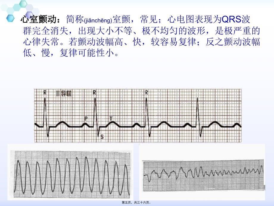 医学专题—心脏骤停与心脑肺复苏30032_第5页