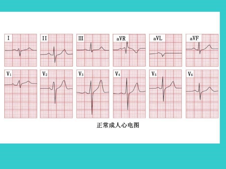 常见严重心律失常的识别与治疗_第5页