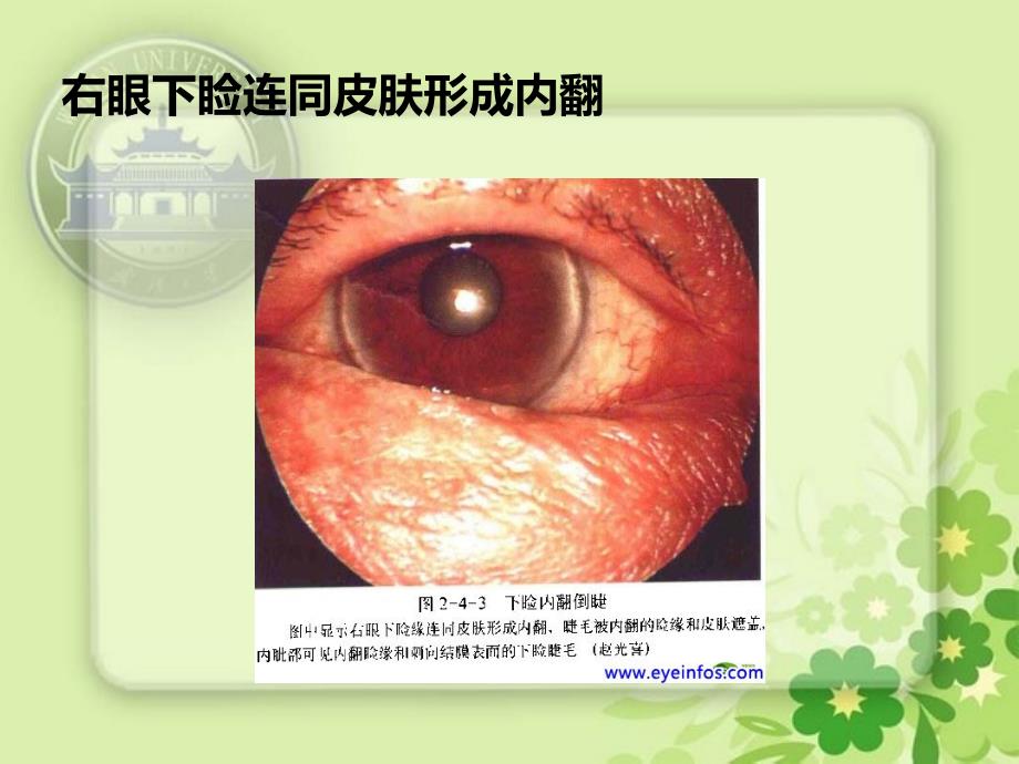 睑内翻和倒睫PPT课件_第4页