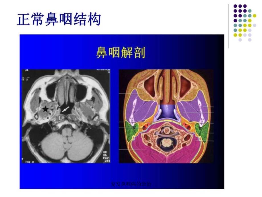 复鼻咽癌的诊治课件_第3页