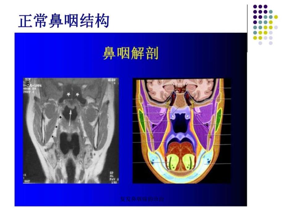 复鼻咽癌的诊治课件_第4页