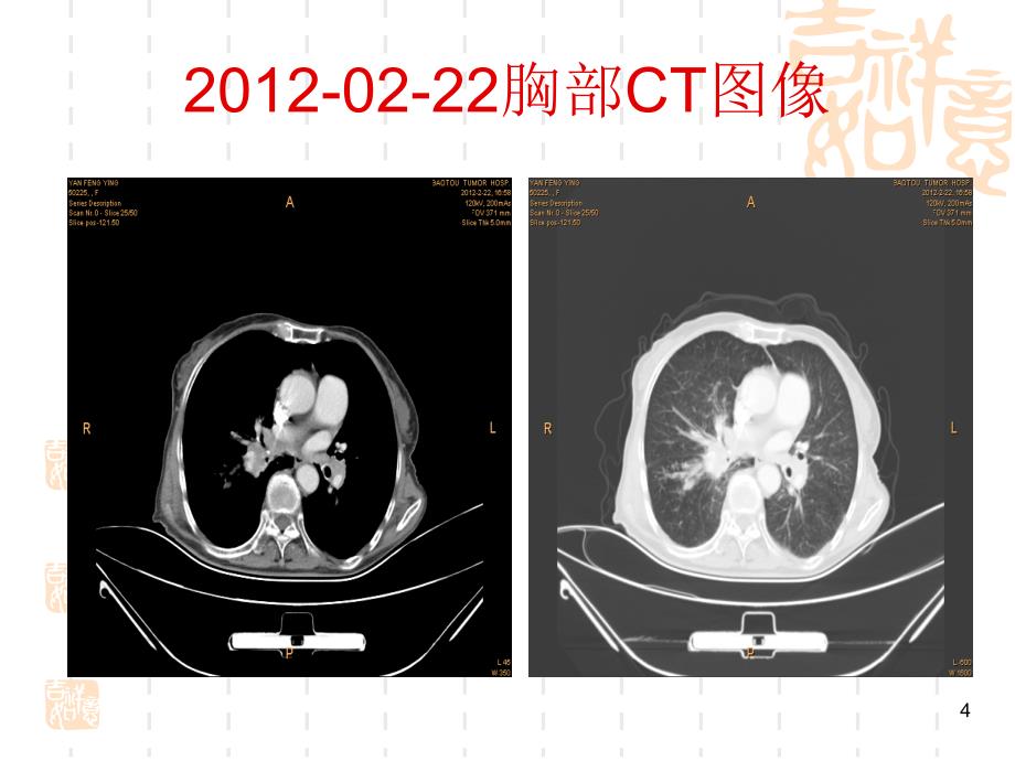 肺癌癌性淋巴管炎PPT课件_第4页