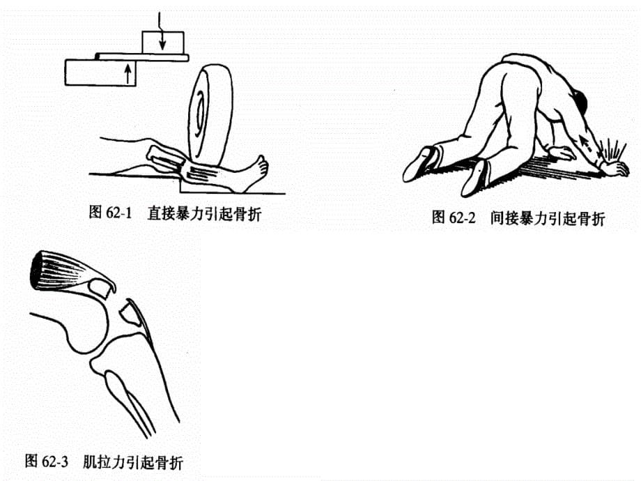 基础医学骨折后康复课件_第5页