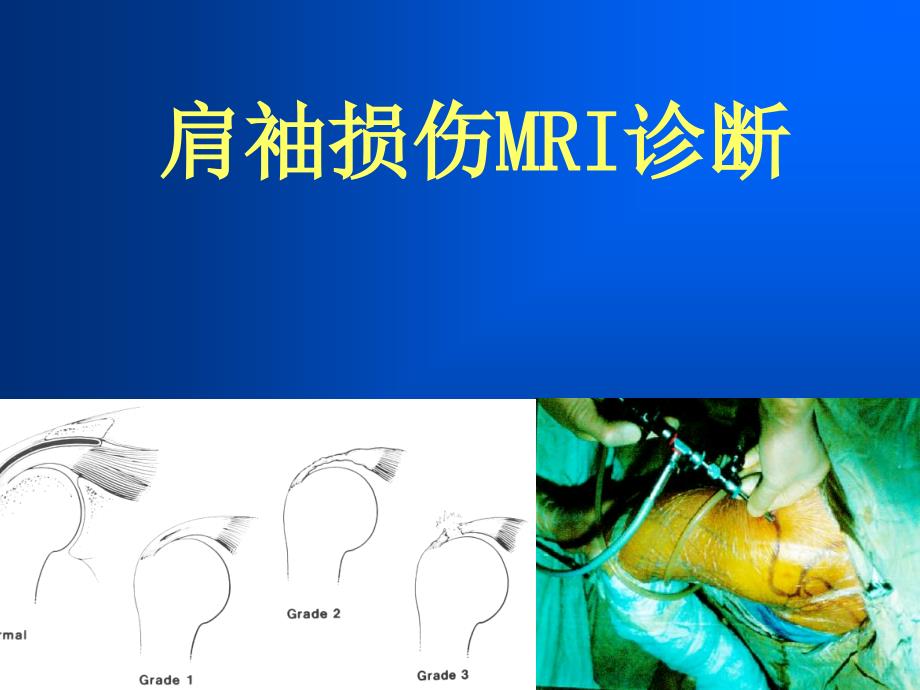 肩袖损伤MRI诊断_第1页