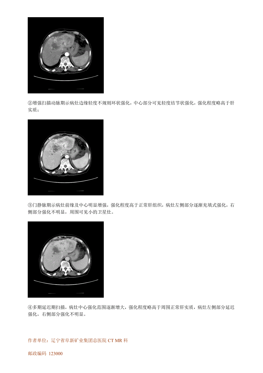 螺旋CT多期增强扫描在肝内周围型胆管细胞癌诊断中的应用价值.doc_第4页