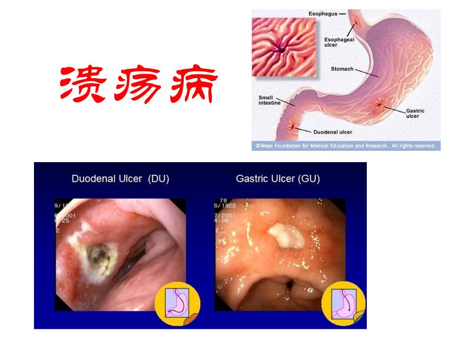 医学影像诊断学：胃十二指肠_第4页