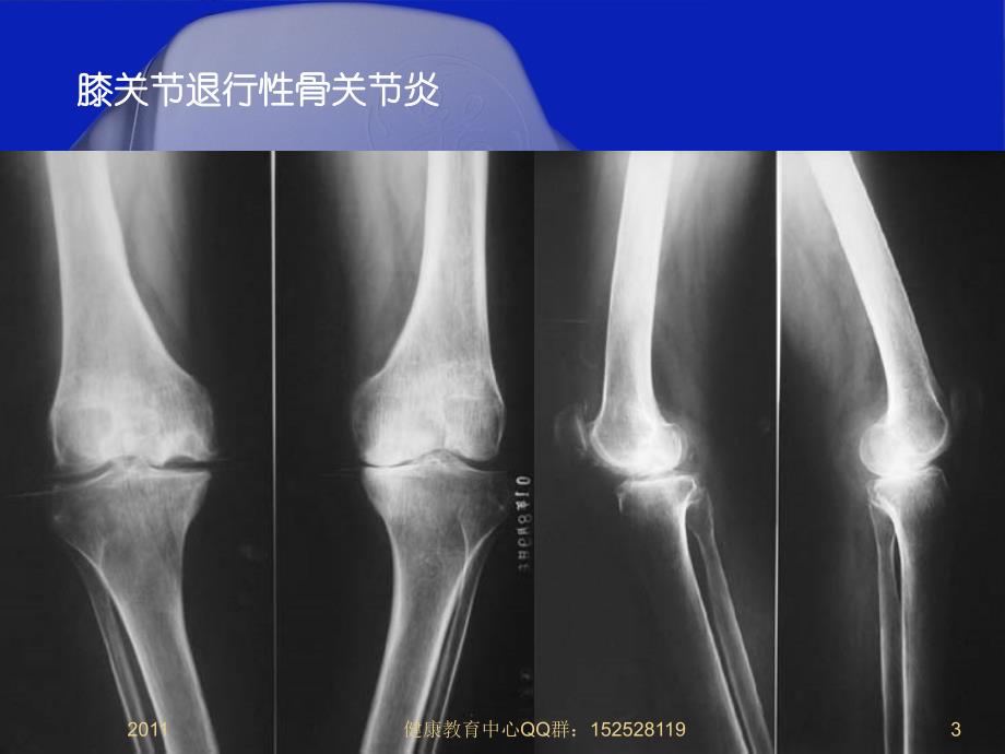 潘良春2《骨关节炎的家庭防治》课件_第3页