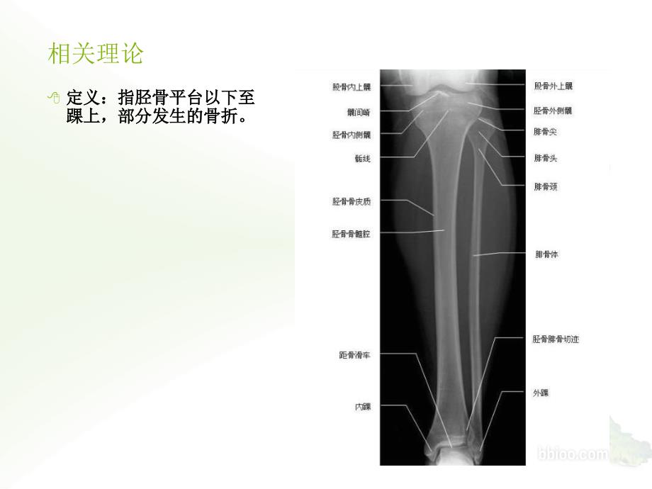 胫腓骨骨折病例讨论_第4页