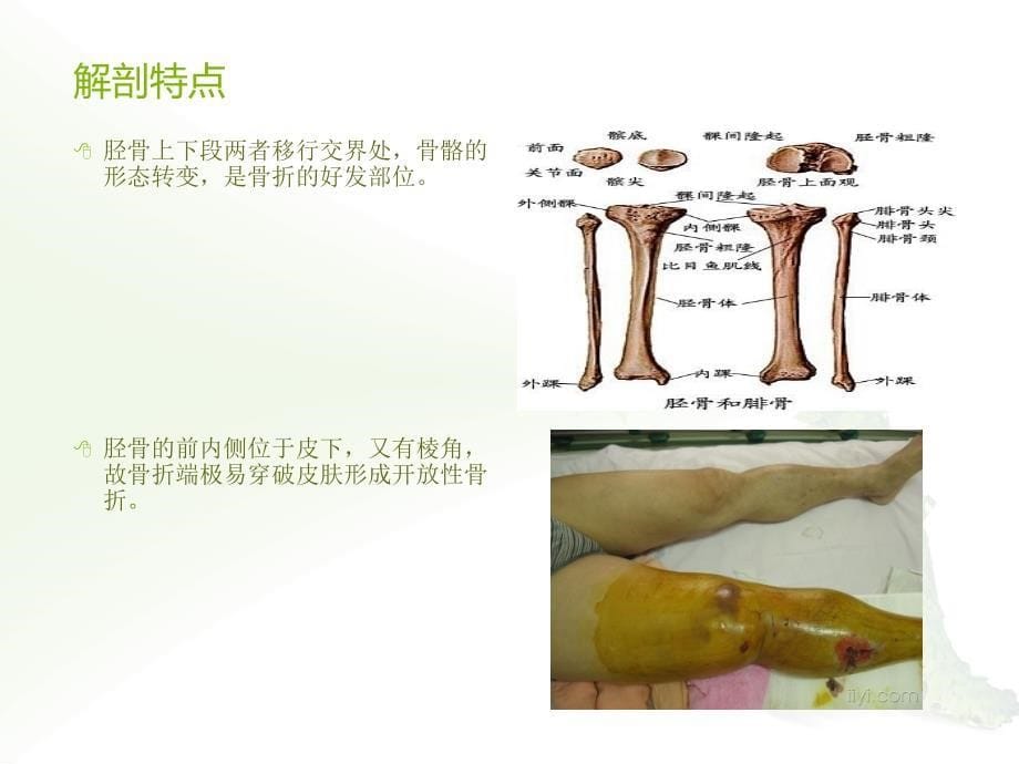 胫腓骨骨折病例讨论_第5页