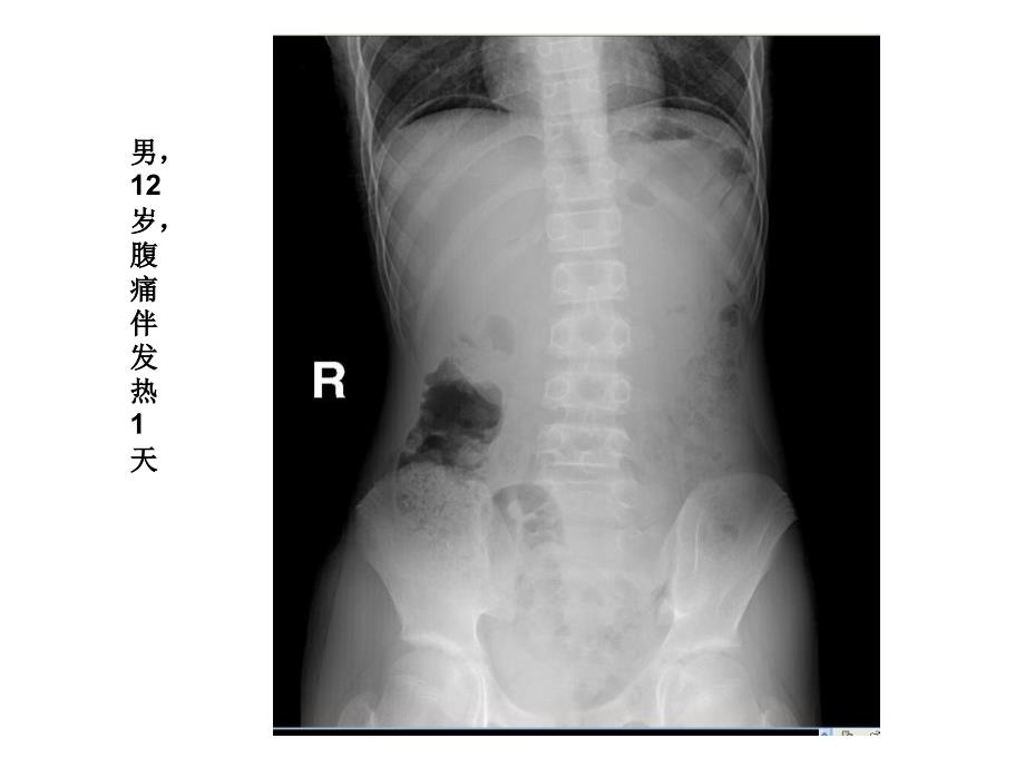 胃肠道常见病、多发病_第3页