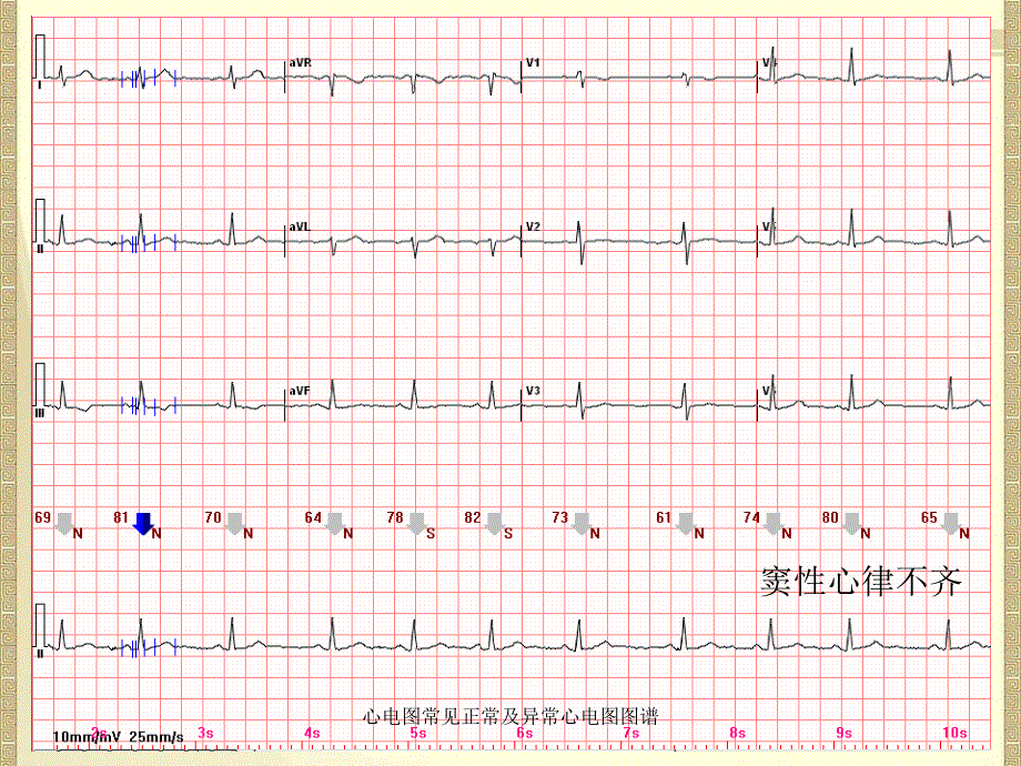 心电图常见正常及异常心电图图谱_第3页