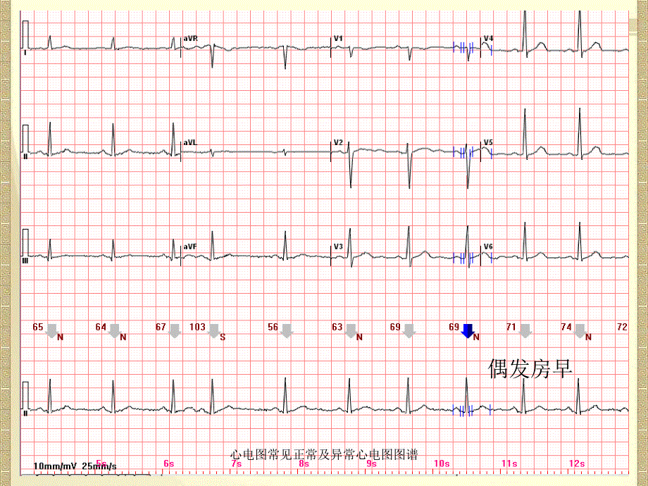心电图常见正常及异常心电图图谱_第4页