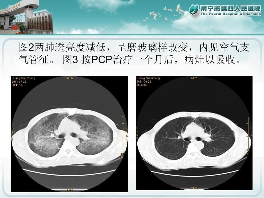 AIDS胸部影像.ppt_第5页