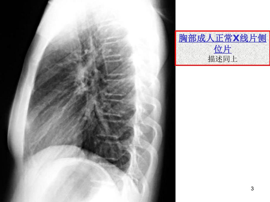 执业医师技能考试X线诊断ppt课件.ppt_第3页