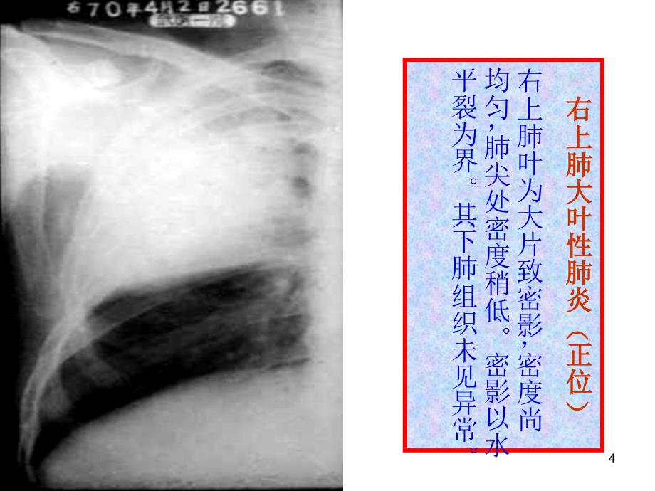 执业医师技能考试X线诊断ppt课件.ppt_第4页