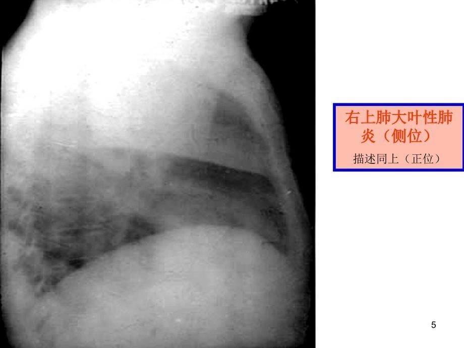 执业医师技能考试X线诊断ppt课件.ppt_第5页