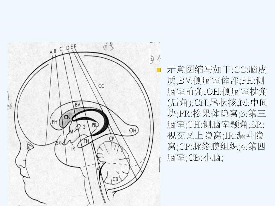 新生儿颅脑超声检查妇幼保健院_第5页